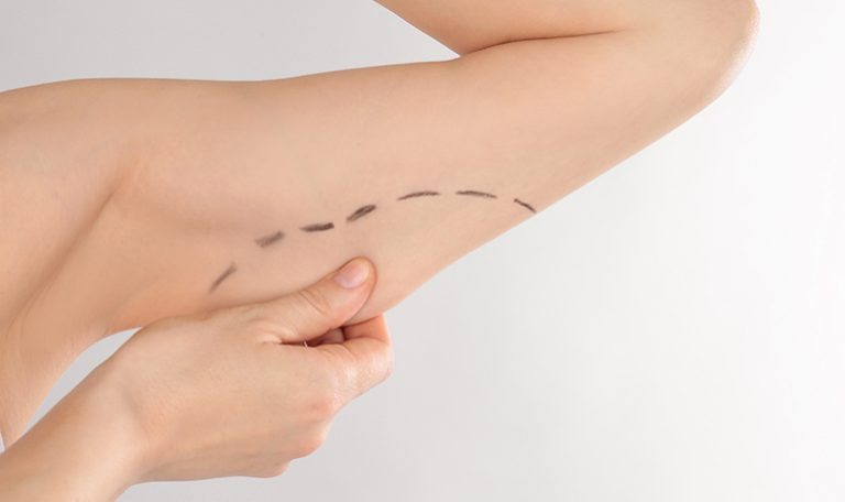 Woman with marks on arm for cosmetic surgery operation against g